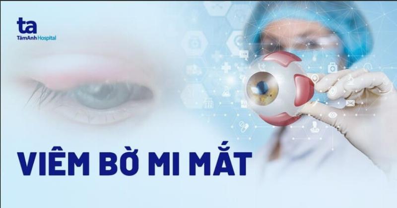 Thuốc Điều Trị Viêm Bờ Mi Mắt: Hiểu Rõ Để Chữa Lành Hiệu Quả